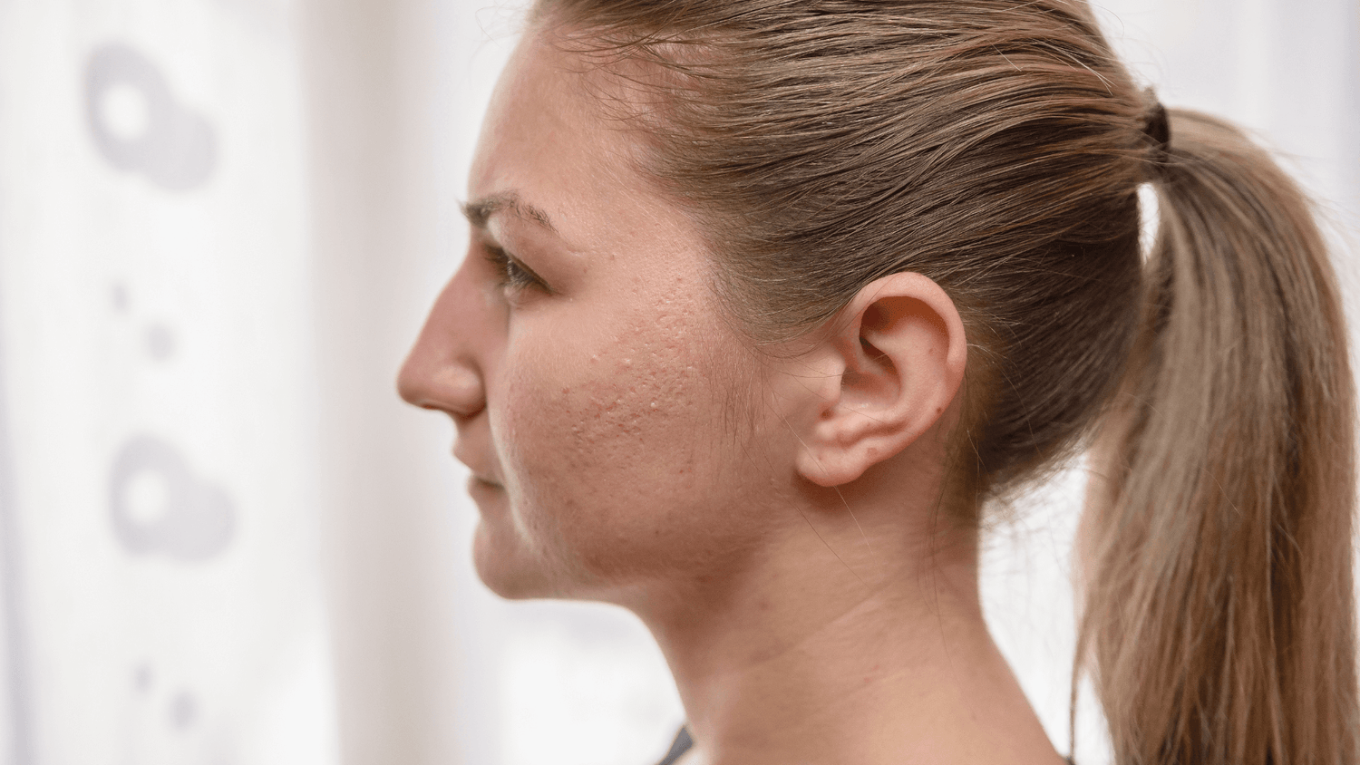 cicatrice acnes