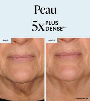 APPAREIL LIGHTINDERM